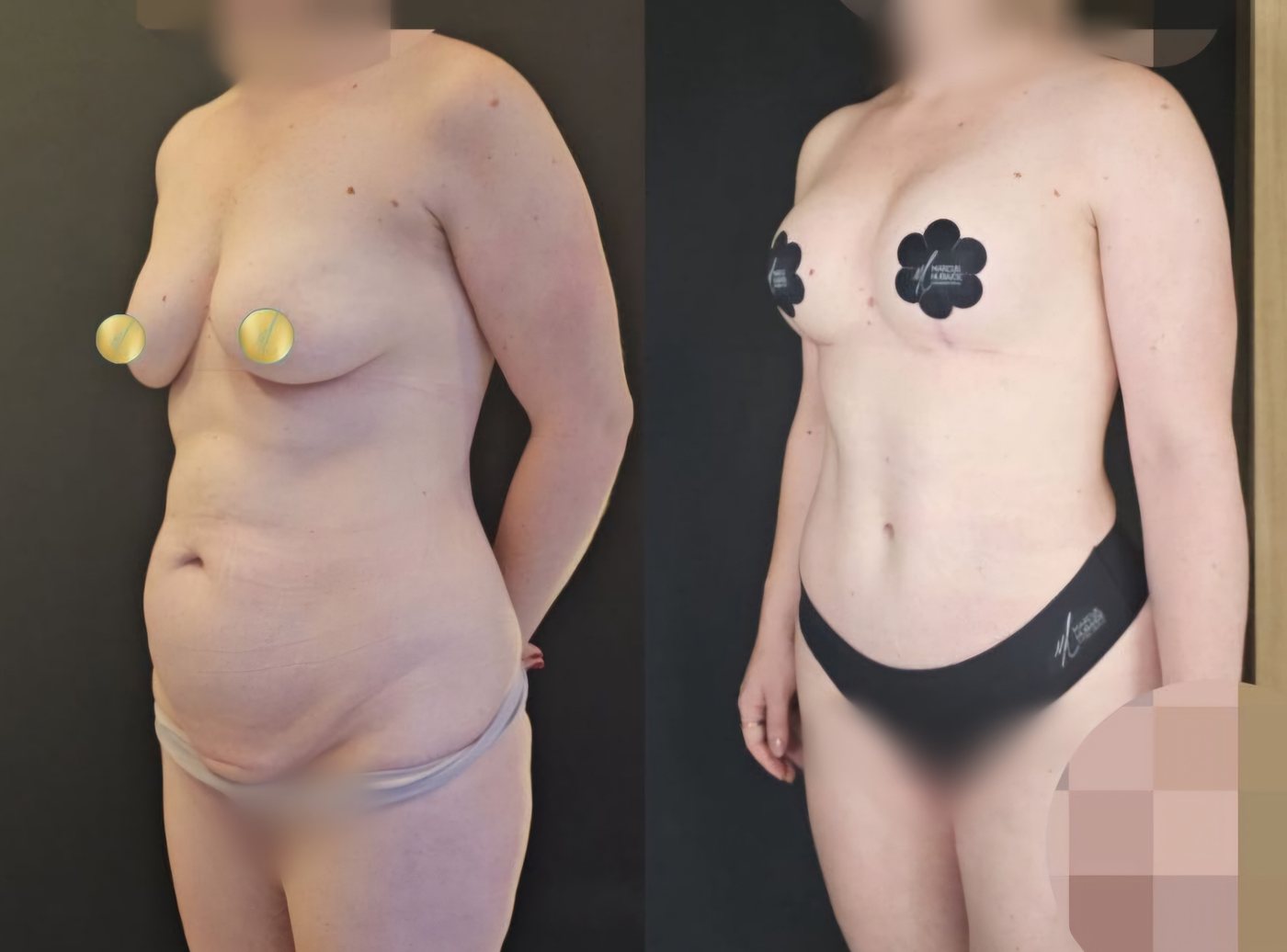 Antes e depois de abdominoplastia com mastopexia, caso 1