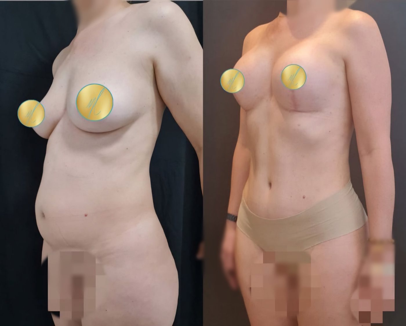 Antes e depois de abdominoplastia com mastopexia, caso 2