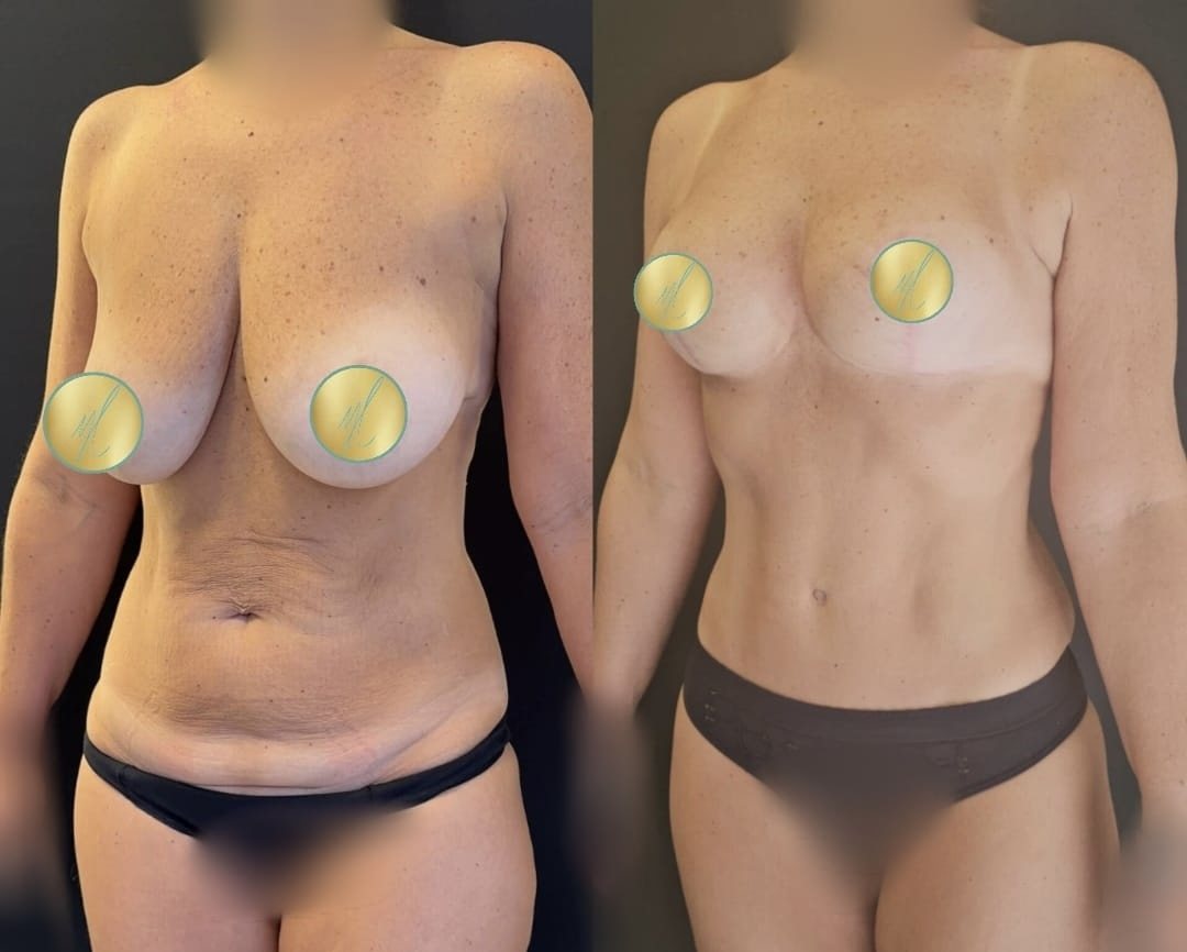 Antes e depois de abdominoplastia com mastopexia, caso 3