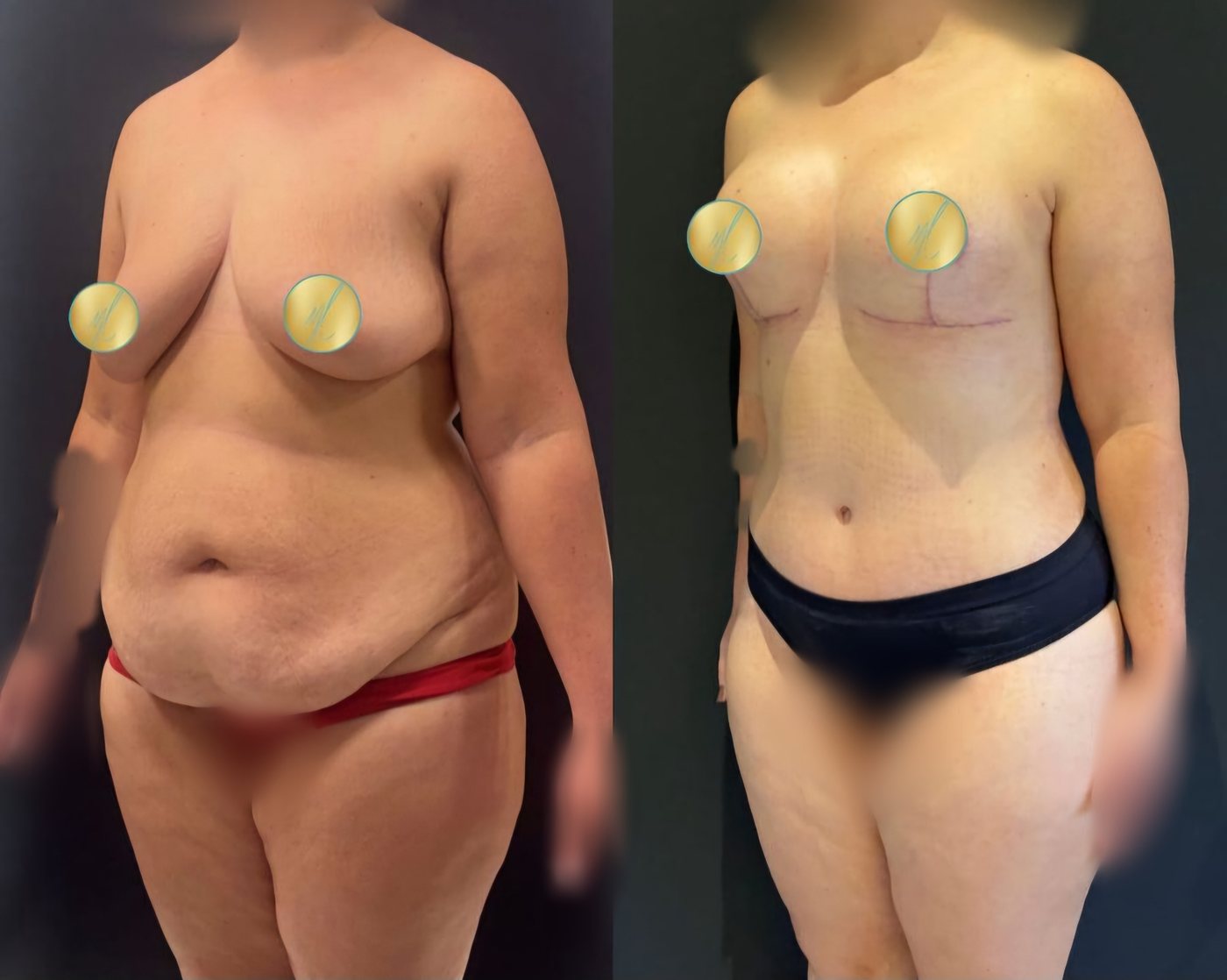 Antes e depois de abdominoplastia com mastopexia, caso 4