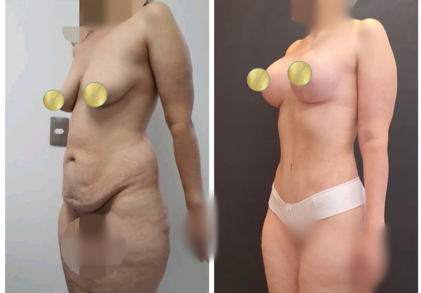 Antes e depois de abdominoplastia com mastopexia, caso 5