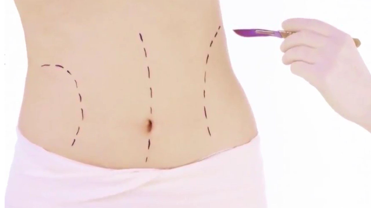 Abdominoplastia