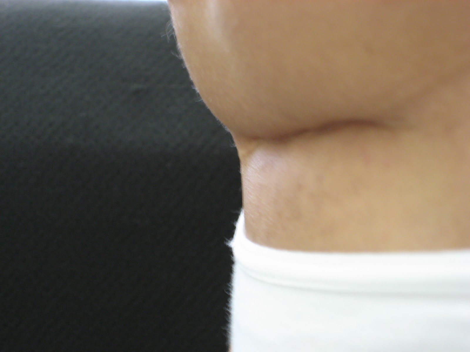 Correção de cicatriz barriga retraída