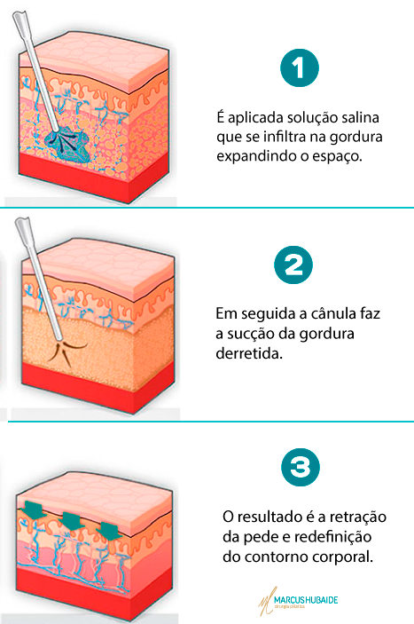 etapas