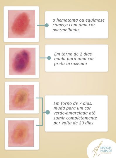 equimose