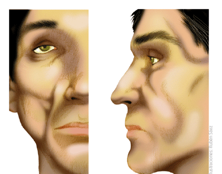 lipoatrofia-facial-grau-3