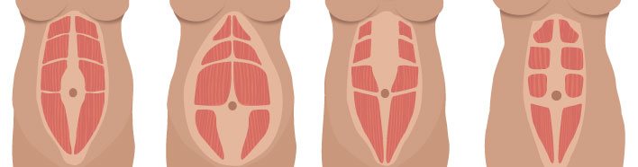 musculatura-com-diastases