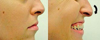 ponta-nasal