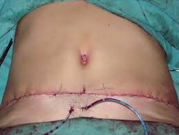 seroma