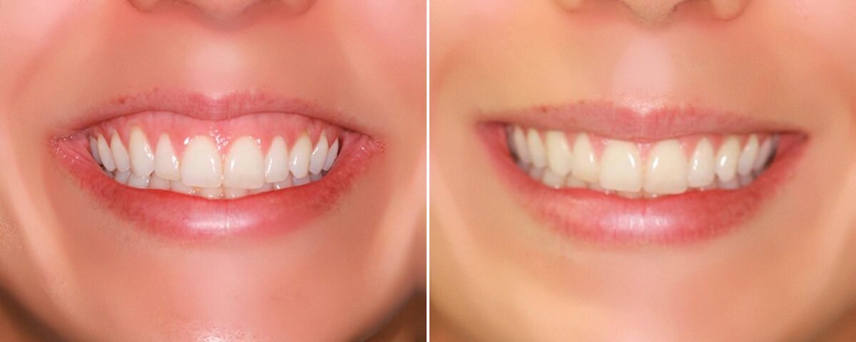 sorriso-gengival-botox-goias-goiania-large-1200x480