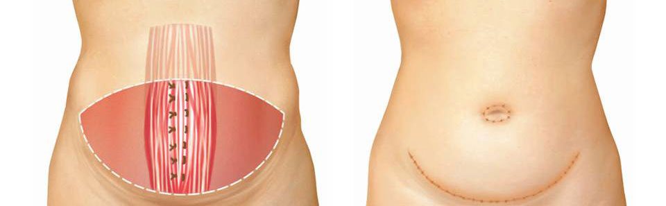 tipos-abdominoplastia