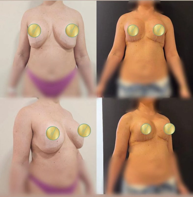 Antes e depois de mamoplastia, caso 01