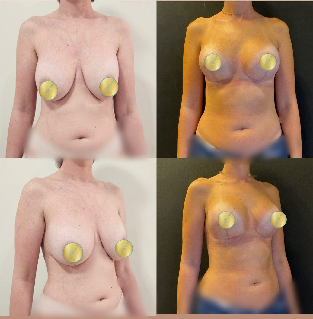 Antes e depois de mamoplastia, caso 03