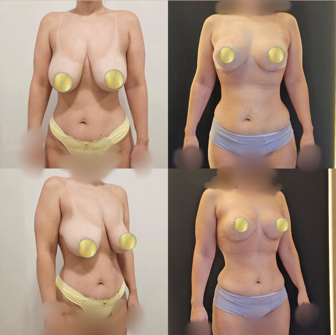 Antes e depois de mamoplastia redutora com técnica Short Scar, caso 01