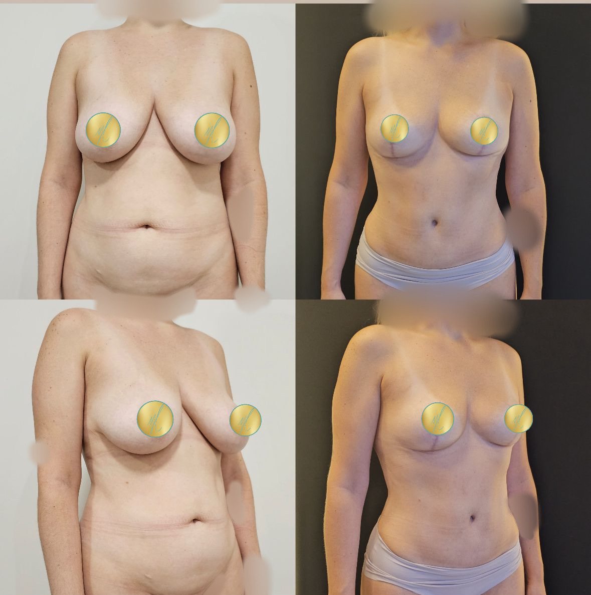 Antes e depois de mamoplastia redutora, caso 02