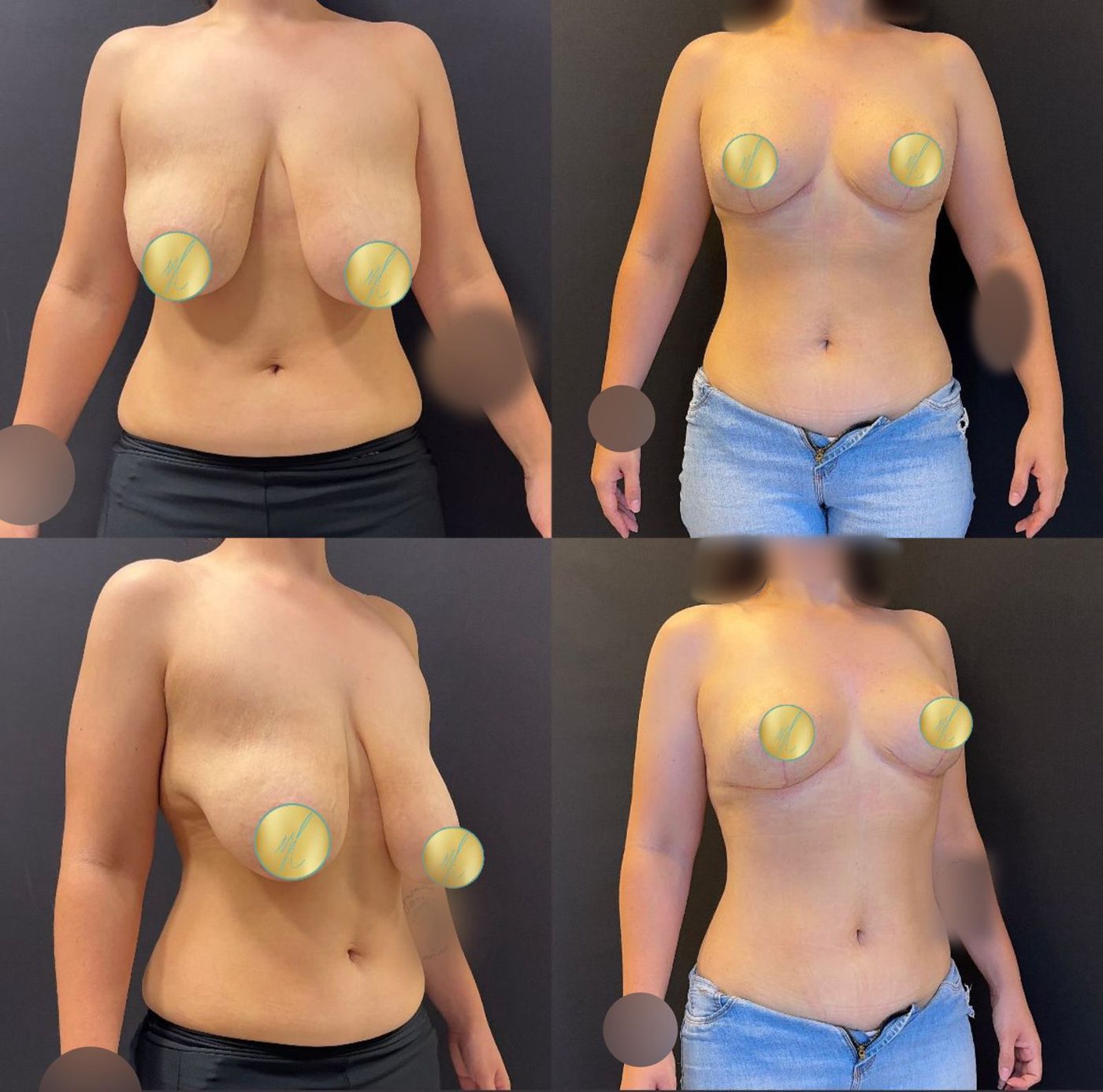 Antes e depois de mamoplastia redutora, caso 03