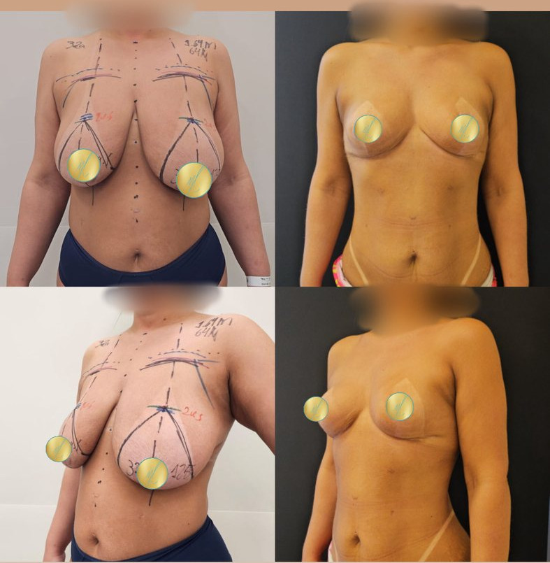 Antes e depois de mamoplastia redutora, caso 04
