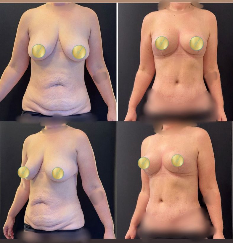 Antes e depois de mastopexia sem implantes, caso 02