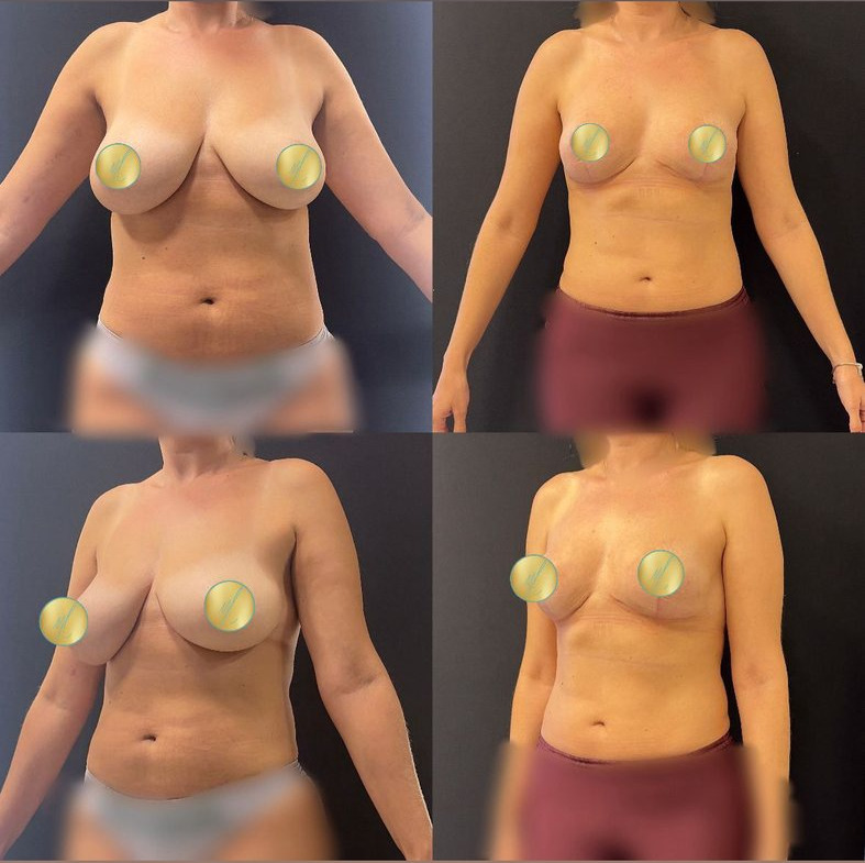 Antes e depois de mastopexia sem implantes, caso 03